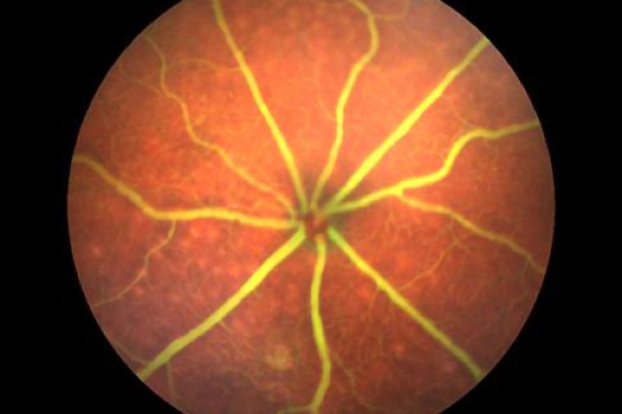 ophthalmoscope view of a retina